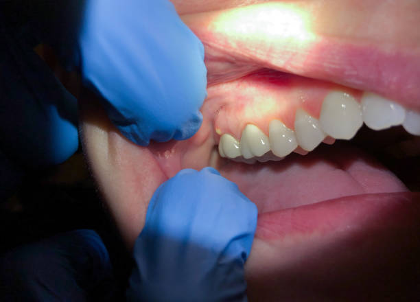 Best Emergency Dental Care for Broken or Chipped Teeth in Lavonia, GA
